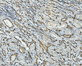 IHC staining of FFPE human glioma with CD34 antibody. HIER: boil tissue sections in pH8 EDTA for 20 min and allow to cool before testing.