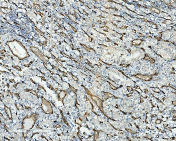 IHC staining of FFPE human glioma with CD34 antibody. HIER: boil tissue sections in pH8 EDTA for 20 min and allow to cool before testing.