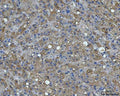 IHC staining of FFPE human liver cancer tissue with BI-1 antibody. HIER: boil tissue sections in pH8 EDTA for 20 min and allow to cool before testing.