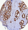 IHC staining of FFPE human prostate carcinoma tissue with PCNA antibody (clone PCNA/8633R). HIER: boil tissue sections in pH 9 10mM Tris with 1mM EDTA for 20 min and allow to cool before testing.