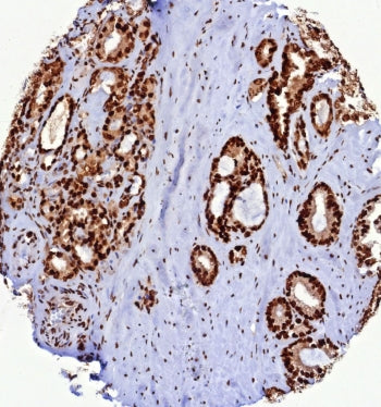 IHC staining of FFPE human prostate carcinoma tissue with PCNA antibody (clone PCNA/8633R). HIER: boil tissue sections in pH 9 10mM Tris with 1mM EDTA for 20 min and allow to cool before testing.