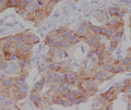 IHC staining of FFPE human breast cancer tissue with Phospho-mTOR antibody antibody. HIER: boil tissue sections in pH8 EDTA for 20 min and allow to cool before testing.