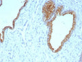 IHC staining of FFPE human prostate carcinoma tissue with CK5/6 antibody (clone KRT5.6/9104). HIER: boil tissue sections in pH 9 10mM Tris with 1mM EDTA for 20 min and allow to cool before testing.