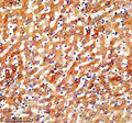 IHC analysis of SLC46A3 using anti-SLC46A3 antibody. SLC46A3 was detected in a paraffin-embedded section of human liver cancer tissue. Heat mediated antigen retrieval was performed in EDTA buffer (pH 8.0, epitope retrieval solution). The tissue section was blocked with 10% goat serum. The tissue section was then incubated with 2 ug/ml rabbit anti-SLC46A3 antibody overnight at 4oC. Peroxidase Conjugated Goat Anti-rabbit IgG was used as secondary antibody and incubated for 30 min at 37oC.