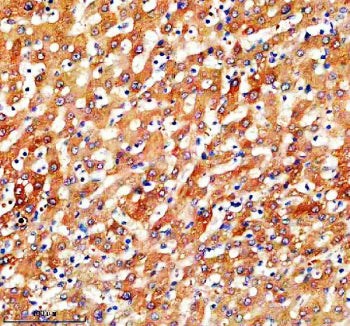 IHC analysis of SLC46A3 using anti-SLC46A3 antibody. SLC46A3 was detected in a paraffin-embedded section of human liver cancer tissue. Heat mediated antigen retrieval was performed in EDTA buffer (pH 8.0, epitope retrieval solution). The tissue section was blocked with 10% goat serum. The tissue section was then incubated with 2 ug/ml rabbit anti-SLC46A3 antibody overnight at 4oC. Peroxidase Conjugated Goat Anti-rabbit IgG was used as secondary antibody and incubated for 30 min at 37oC.