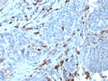 IHC staining of FFPE human tumor with recombinant IgM antibody (clone IGHM/3135R). HIER: boil tissue sections in pH 9 10mM Tris with 1mM EDTA for 10-20 min and allow to cool before testing.