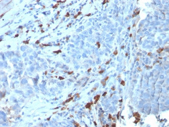 IHC staining of FFPE human tumor with recombinant IgM antibody (clone IGHM/3135R). HIER: boil tissue sections in pH 9 10mM Tris with 1mM EDTA for 10-20 min and allow to cool before testing.