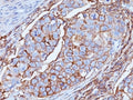 IHC analysis of formalin-fixed, paraffin-embedded human breast carcinoma stained with CD44 antibody (clone DF1485).