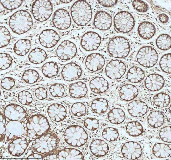 Immunohistochemical staining of MYH14 using anti-MYH14 antibody. MYH14 was detected in a paraffin-embedded section of human colon cancer tissue. Heat mediated antigen retrieval was performed in EDTA buffer (pH 8.0, epitope retrieval solution). The tissue section was blocked with 10% goat serum. The tissue section was then incubated with 2 ug/ml rabbit anti-MYH14 antibody overnight at 4oC. Peroxidase Conjugated Goat Anti-rabbit IgG was used as secondary antibody and incubated for 30 min at 37oC.