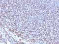 IHC testing of FFPE Ewings sarcoma with recombinant NKX2.2 antibody (clone NX2/2198R). HIER: steam sections in 10mM citrate buffer, pH 6.0, for 10-20 min.