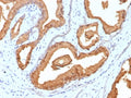 IHC staining of FFPE human prostate carcinoma tissue with Prostate Specific Antigen antibody (clone rKLK3/6947). HIER: boil tissue sections in pH 9 10mM Tris with 1mM EDTA for 20 min and allow to cool before testing.