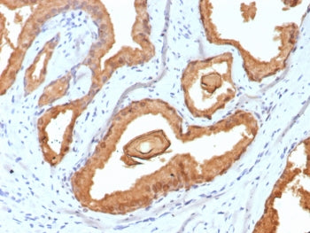 IHC staining of FFPE human prostate carcinoma tissue with Prostate Specific Antigen antibody (clone rKLK3/6947). HIER: boil tissue sections in pH 9 10mM Tris with 1mM EDTA for 20 min and allow to cool before testing.