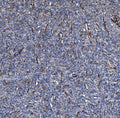 IHC staining of FFPE human skin cancer tissue with COL4A3 antibody. HIER: boil tissue sections in pH8 EDTA for 20 min and allow to cool before testing.