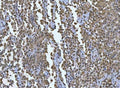 IHC staining of FFPE human testicular germ cell tumor tissue with TCF-8 antibody. HIER: boil tissue sections in pH8 EDTA for 20 min and allow to cool before testing.