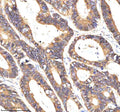 Immunohistochemical staining of NAXE using anti-NAXE antibody. NAXE was detected in a paraffin-embedded section of human colon cancer tissue. Heat mediated antigen retrieval was performed in EDTA buffer (pH 8.0, epitope retrieval solution). The tissue section was blocked with 10% goat serum. The tissue section was then incubated with 2 ug/ml rabbit anti-NAXE antibody overnight at 4oC. Peroxidase Conjugated Goat Anti-rabbit IgG was used as secondary antibody and incubated for 30 min at 37oC.