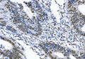 IHC staining of FFPE human rectal cancer tissue with TLS antibody. HIER: boil tissue sections in pH8 EDTA for 20 min and allow to cool before testing.