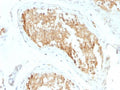 IHC staining of FFPE human testicular carcinoma with ALDH1A1 antibody (clone ALDH1A1/1381). HIER: boil tissue sections in pH 9 10mM Tris with 1mM EDTA for 10-20 min and allow to cool before testing.
