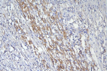 IHC staining of FFPE human liver cancer with CD46 antibody. HIER: boil tissue sections in pH8 EDTA for 20 min and allow to cool before testing.