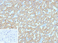 IHC staining of FFPE human hepatocellular carcinoma tissue with HSD17B13 antibody (clone HSD17B13/13110). Inset: PBS used in place of primary Ab (secondary Ab negative control). HIER: boil tissue sections in pH 9 10mM Tris with 1mM EDTA for 20 min and allow to cool before testing.