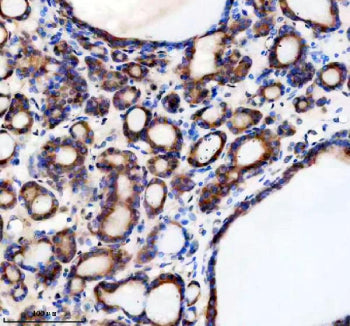 Immunohistochemical staining of TMED1 using anti-TMED1 antibody. TMED1 was detected in a paraffin-embedded section of human thyroid cancer tissue. Heat mediated antigen retrieval was performed in EDTA buffer (pH 8.0, epitope retrieval solution). The tissue section was blocked with 10% goat serum. The tissue section was then incubated with 2 ug/ml rabbit anti-TMED1 antibody overnight at 4oC. Peroxidase Conjugated Goat Anti-rabbit IgG was used as secondary antibody and incubated for 30 min at 37oC.