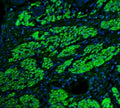 Immunofluorescent staining of FFPE human esophagus cancer tissue with TAGLN antibody (green) and DAPI nuclear stain (blue). HIER: steam section in pH8 EDTA buffer for 20 min.