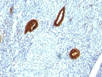 IHC analysis of formalin-fixed, paraffin-embedded human endometrial carcinoma stained with anti-CK19 antibody (clone SPM266).