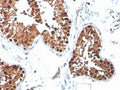 IHC staining of FFPE human testicular carcinoma with INHA antibody (clone R1). HIER: boil tissue sections in pH 9 10mM Tris with 1mM EDTA for 20 min and allow to cool before testing.