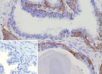 IHC staining of FFPE human prostate cancer tissue with recombinant CK15 antibody (clone KRT15/9088R). Inset: PBS used in place of primary Ab (secondary Ab negative control). HIER: boil tissue sections in pH 9 10mM Tris with 1mM EDTA for 20 min and allow to cool before testing.