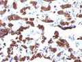 IHC: Formalin-fixed, paraffin-embedded human thyroid carcinoma stained with TG antibody (TGB24).