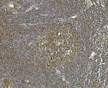 IHC staining of FFPE metastatic human rectal cancer in lymph node with HSPA8 antibody. HIER: boil tissue sections in pH8 EDTA for 20 min and allow to cool before testing.