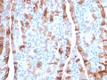 IHC staining of FFPE human thyroid carcinoma with TPO antibody. HIER: boil tissue sections in pH 9 10mM Tris with 1mM EDTA for 20 min and allow to cool before testing.
