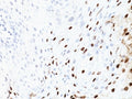 IHC: Formalin-fixed, paraffin-embedded human cervix stained with HPV-16 antibody (SPM405)