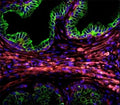 Confocal immunofluorescent analysis of Cytokeratin-18 antibody with prostate carcinoma followed by Alexa Fluor 488-conjugated goat anti-rabbit lgG (green). DAPI was used as a nuclear counterstain (blue).