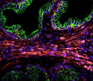 Confocal immunofluorescent analysis of Cytokeratin-18 antibody with prostate carcinoma followed by Alexa Fluor 488-conjugated goat anti-rabbit lgG (green). DAPI was used as a nuclear counterstain (blue).