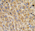 IHC analysis of FFPE human hepatocarcinoma with ADAMTS13 antibody