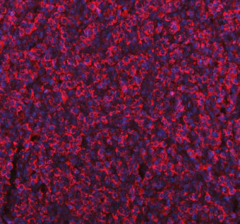 Immunofluorescent staining of FFPE human gastric cancer tissue with ME1 antibody (red) and DAPI nuclear stain (blue). HIER: steam section in pH8 EDTA buffer for 20 min.