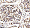Immunohistochemical staining of DNAJB6 using anti-DNAJB6 antibody. DNAJB6 was detected in a paraffin-embedded section of human lung cancer tissue. Heat mediated antigen retrieval was performed in EDTA buffer (pH 8.0, epitope retrieval solution). The tissue section was blocked with 10% goat serum. The tissue section was then incubated with 2 ug/ml rabbit anti-DNAJB6 antibody overnight at 4oC. Peroxidase Conjugated Goat Anti-rabbit IgG was used as secondary antibody and incubated for 30 min at 37oC.