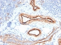 IHC staining of FFPE human renal cell carcinoma with MTF1 antibody. HIER: boil tissue sections in pH 9 10mM Tris with 1mM EDTA for 20 min and allow to cool before testing.