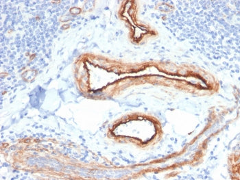IHC staining of FFPE human renal cell carcinoma with MTF1 antibody. HIER: boil tissue sections in pH 9 10mM Tris with 1mM EDTA for 20 min and allow to cool before testing.