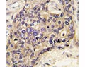 IHC analysis of FFPE human hepatocarcinoma tissue stained with HGF antibody