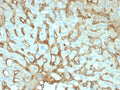 IHC testing of FFPE human hepatocellular carcinoma with human Albumin antibody (clone ALB/2141). Required HIER: boil tissue sections in 10mM citrate buffer, pH6, for 10-20 min followed by cooling at RT for 20 min.