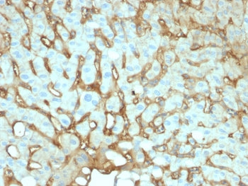 IHC testing of FFPE human hepatocellular carcinoma with human Albumin antibody (clone ALB/2141). Required HIER: boil tissue sections in 10mM citrate buffer, pH6, for 10-20 min followed by cooling at RT for 20 min.