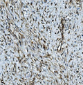 IHC staining of FFPE human breast cancer with MMP2 antibody. HIER: boil tissue sections in pH8 EDTA for 20 min and allow to cool before testing.