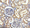 Immunohistochemical staining of TRIM10 using anti-TRIM10 antibody. TRIM10 was detected in a paraffin-embedded section of human liver cancer tissue. Heat mediated antigen retrieval was performed in EDTA buffer (pH 8.0, epitope retrieval solution). The tissue section was blocked with 10% goat serum. The tissue section was then incubated with 2 ug/ml rabbit anti-TRIM10 antibody overnight at 4oC. Peroxidase Conjugated Goat Anti-rabbit IgG was used as secondary antibody and incubated for 30 min at 37oC.