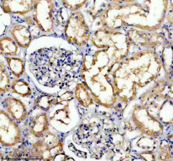 Immunohistochemical staining of TRIM10 using anti-TRIM10 antibody. TRIM10 was detected in a paraffin-embedded section of human liver cancer tissue. Heat mediated antigen retrieval was performed in EDTA buffer (pH 8.0, epitope retrieval solution). The tissue section was blocked with 10% goat serum. The tissue section was then incubated with 2 ug/ml rabbit anti-TRIM10 antibody overnight at 4oC. Peroxidase Conjugated Goat Anti-rabbit IgG was used as secondary antibody and incubated for 30 min at 37oC.