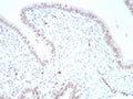 IHC staining of FFPE human ovarian carcinoma tissue with Paired box 4 antibody (clone PAX4/7599). HIER: boil tissue sections in pH 9 10mM Tris with 1mM EDTA for 20 min and allow to cool before testing.