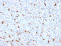 IHC staining of FFPE human hepatocellular carcinoma with C1QB antibody. HIER: boil tissue sections in pH 9 10mM Tris with 1mM EDTA for 20 min and allow to cool before testing.