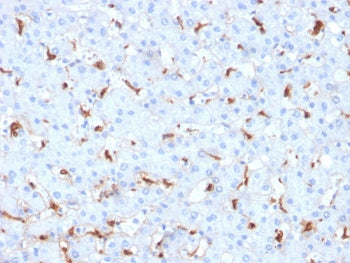 IHC staining of FFPE human hepatocellular carcinoma with C1QB antibody. HIER: boil tissue sections in pH 9 10mM Tris with 1mM EDTA for 20 min and allow to cool before testing.