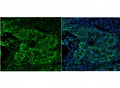 Immunofluorescent staining of FFPE human breast cancer with MCM5 antibody (green) and DAPI nuclear stain (blue). HIER: steam section in pH8 EDTA for 20 min.