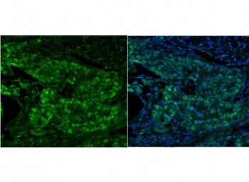 Immunofluorescent staining of FFPE human breast cancer with MCM5 antibody (green) and DAPI nuclear stain (blue). HIER: steam section in pH8 EDTA for 20 min.